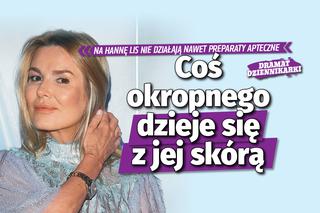 Dramat Hanny Lis. Coś okropnego dzieje się z jej skórą!