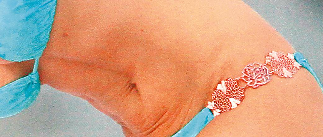 Dżołana odessała sobie tłuszcz