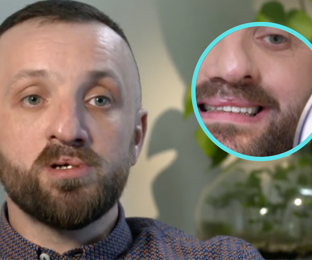 Bił się po twarzy, by uśmierzyć ból. Przeszedł metamorfozę. Nie był to prosty zabieg