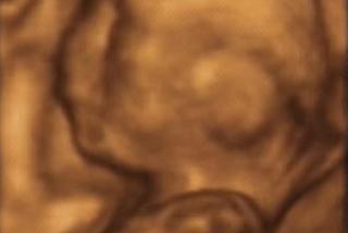 20 tydzień ciąży - zdjęcie USG