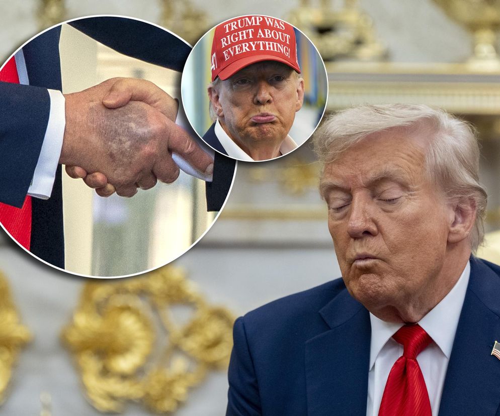 Donald Trump ma kłopoty ze zdrowiem. Nowe zdjęcia wywołały niepokój