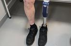 Najstarszy pacjent w Polsce z ultranowoczesną protezą wróci do pracy w ogrodzie 