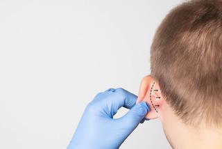 Korekcja uszu, czyli plastyka odstających uszu. Na czym polega?