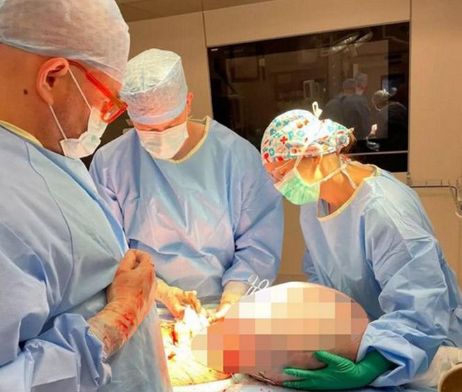 Ogromny guz jajnika usunięty w Centrum Onkologii w Bydgoszczy