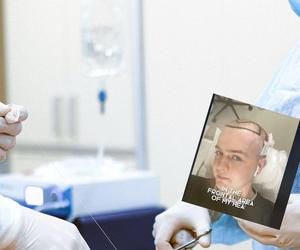 Zdecydował się na przeszczep włosów w Turcji. Jednego nie przewidział