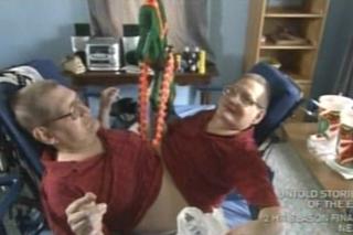Przeżyli zrośnięci 68 lat. Nie żyją najdłużej żyjące bliźnięta syjamskie. Ronnie i Donnie Galyon