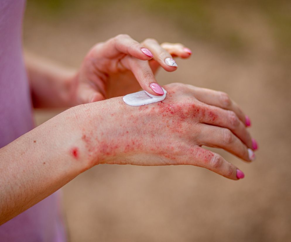 Rozdzierające, pękające pęcherze”. Przez egzemę chciała odrąbać sobie rękę