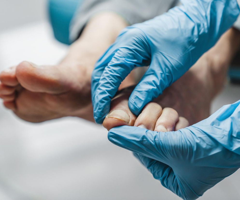 Grzybica paznokci to częsty problem. Poznaj objawy i skuteczne metody leczenia