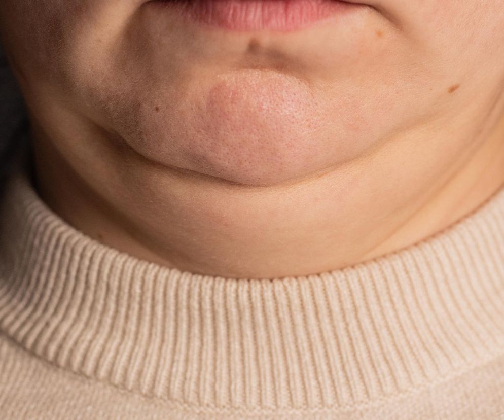 Jak pozbyć się drugiego podbródka bez skalpela? Efekty już po miesiącu