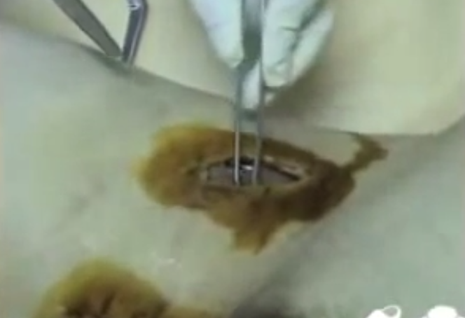 Krokodyl narkotyk i jego skutki (5)