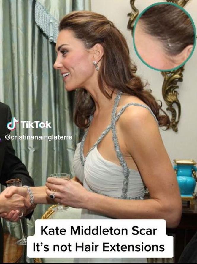 Księżna Kate ma bliznę na skroni