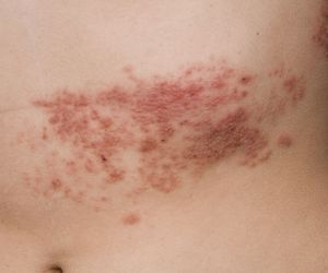 Półpasiec. Czy można uniknąć tej choroby wirusowej? 