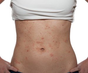 Łupież biały: przyczyny, objawy, leczenie