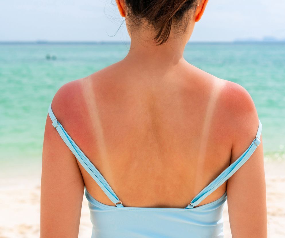 Przynoszą natychmiastową ulgę. Użyj, gdy przesadzisz z opalaniem