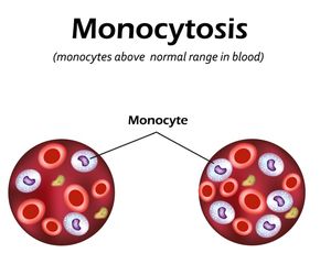Monocytoza: przyczyny. Czy nadmiar monocytów jest groźny?