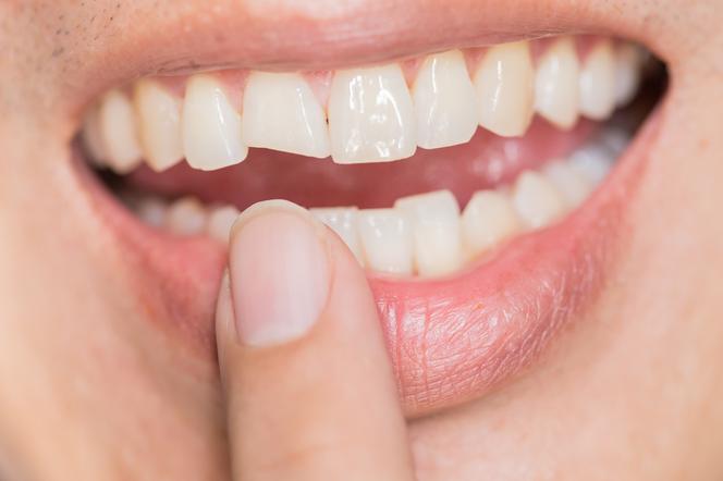 Sennik zęby. Co oznacza sen o zębach?