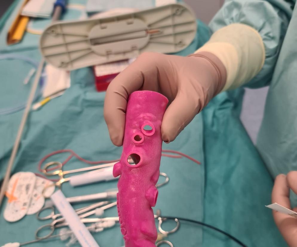 stengraft