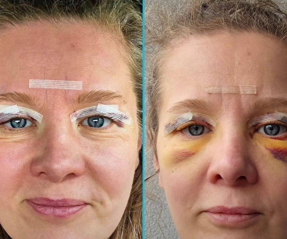 Anna Powierza pokazała zdjęcia po blepharoplastyce. Ten zabieg można zrobić na NFZ