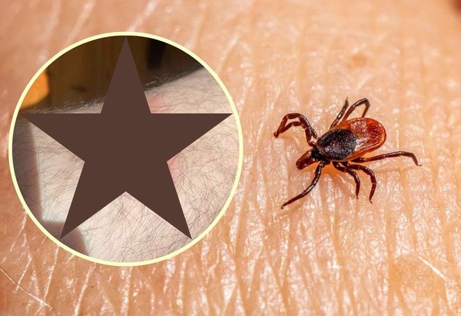 Rumień wędrujący to jeden z pierwszych i najbardziej rozpoznawalnych objawów boreliozy