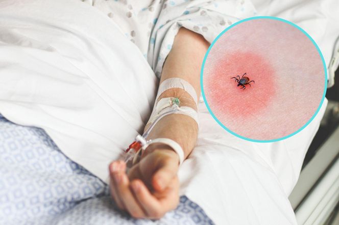 Ugryzł ją kleszcz. Tydzień później już nie żyła
