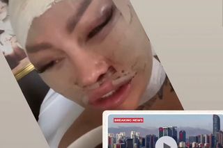 Laluna przeszła kolejną operację. Pokazała, jak wygląda jej twarz tuż po zabiegu 