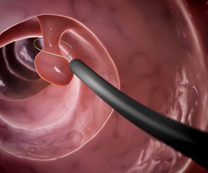 Czy usuwanie polipów jest konieczne?