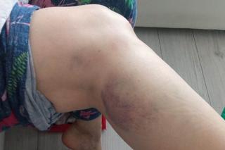 Potrącenie pieszej na pasach na rondzie santockim w Gorzowie. Poszkodowana pokazała poobijane ciało