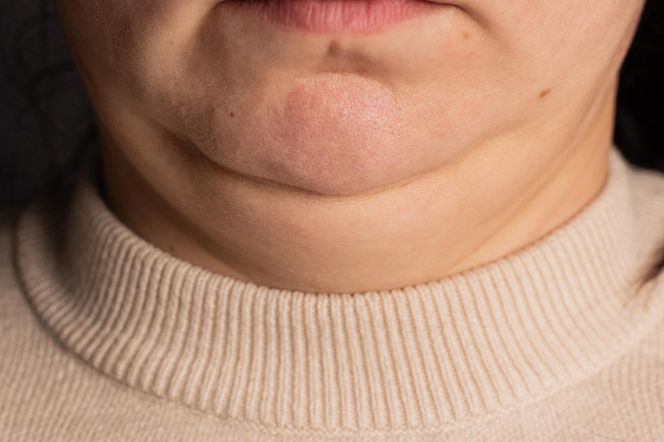 Jak pozbyć się drugiego podbródka bez skalpela? Efekty już po miesiącu