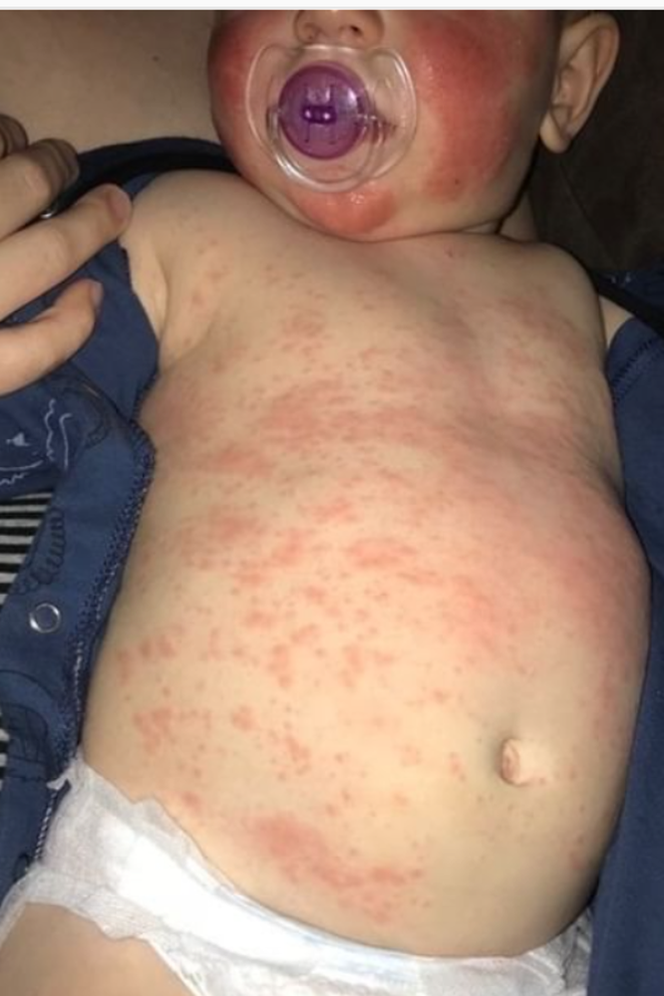 Reakcje alergiczne u dzieci