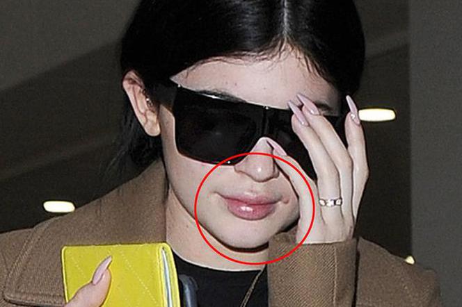 Kylie Jenner POWIĘKSZYŁA USTA! Była tak opuchnięta, że zakrywała twarz przed fotoreporterami! ZDJĘCIA