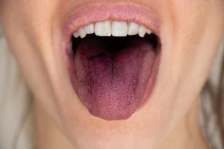 Już 8 razy więcej zachorowań niż przed rokiem, lekarze mówią o pladze. Jakie są objawy szkarlatyny?