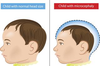 Małogłowie - przyczyny i objawy microcefalii