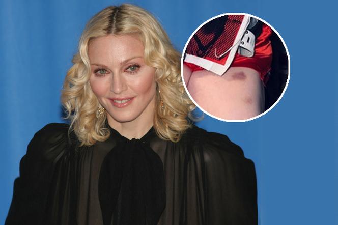 64-letnia Madonna bez majtek i cała w siniakach. Fani przerażeni!