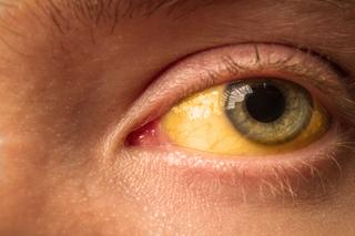 Nietypowe skutki uboczne składnika popularnych leków przeciwbólowych. Wśród nich: zażółcenie białek oczu