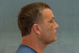 Wydrukowali mu nowe kości twarzy