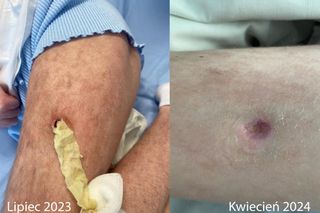 USK we Wrocławiu stawia na skuteczną terapię ran u dzieci