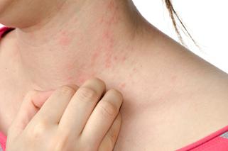 Alergia skórna: jak walczyć z uczuleniem