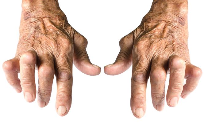 Reumatyzm palindromiczny: przyczyny, objawy, leczenie