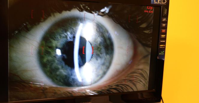 Szpital w Sosnowcu bije rekordy. To absolutny lider w przeszczepach rogówki w Polsce