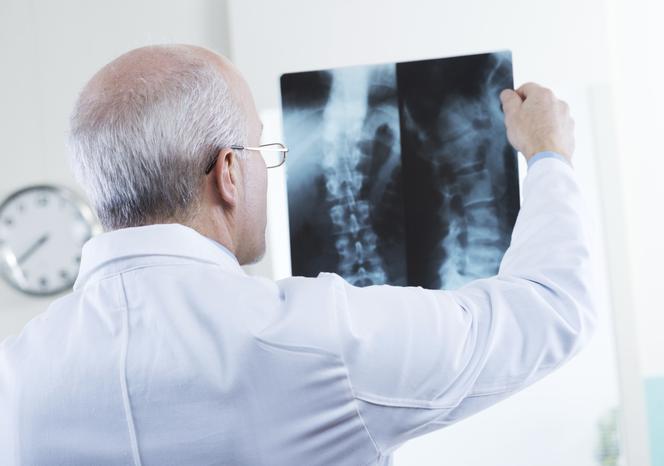 Osteoporoza: jakie badania pozwolą rozpoznać odwapnienie kości?