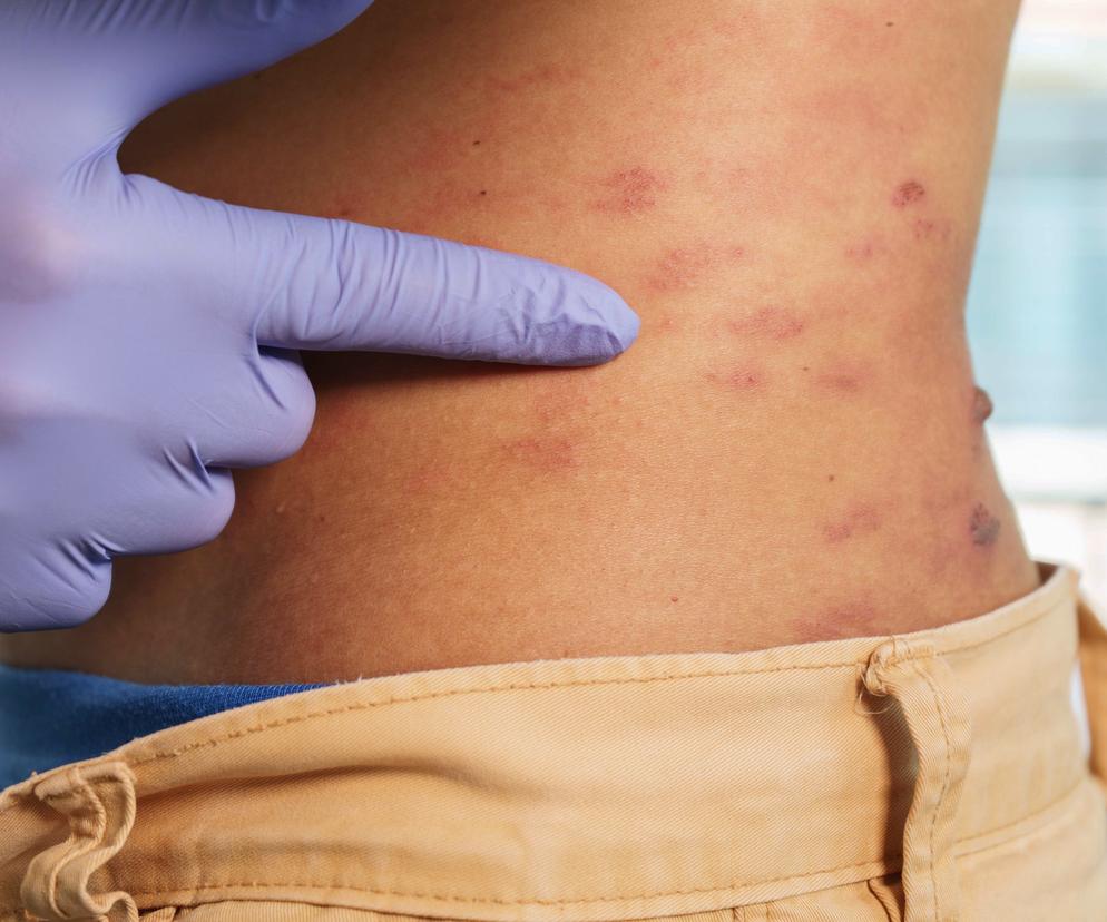 Przeszedłeś tę chorobę? Możesz być narażony na udar