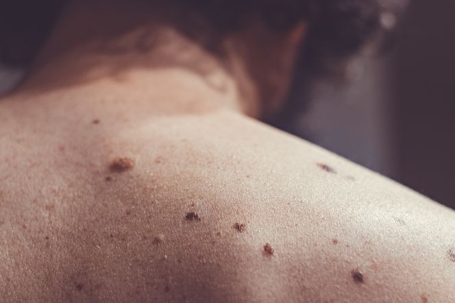 Zbliżenie na plecy z widocznymi zmianami skórnymi