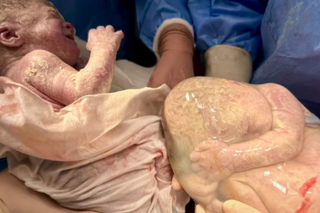 Niezwykły poród bliźniaczek w Warszawie. Jedna spała, druga krzyczała [wideo]