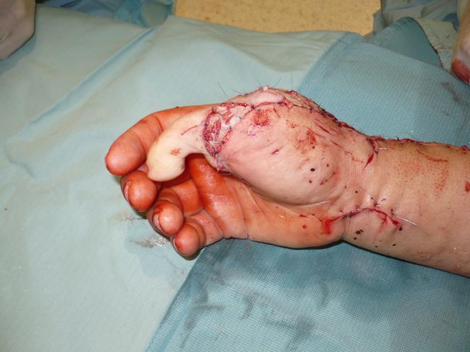 Lekarze przyszyli palec od nogi w miejsce kciuka