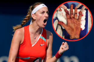 Tak wyglądała dłoń Petry Kvitovej po ataku nożownika! ZDJĘCIE tylko dla ludzi o mocnych nerwach!