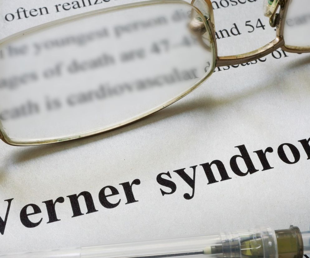  Zespół Wernera - przyczyny, objawy, diagnostyka, leczenie