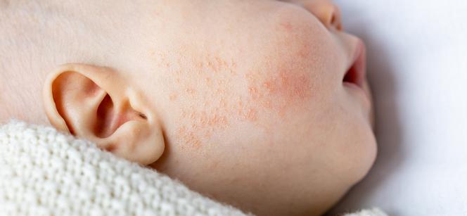 Wysypka alergiczna - jak wygląda i jak ją rozpoznać u dziecka?