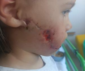 Amstaff rozszarpał buzię 4-letniej Nadii