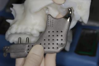 Wydrukowali mu nowe kości twarzy