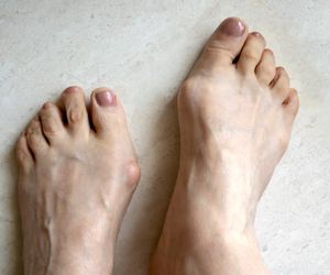 Haluksy - przyczyny, objawy i leczenie